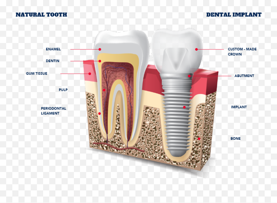 Dental Implants Types Getting New Teeth All - Dental Implants In Jawbone Png,Star Crown Png