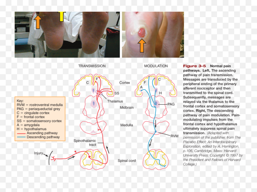 Photos Of Claw Toes Foot Deformity Green Arrow - Diagram Png,Orange Arrow Png