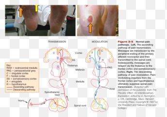 Photos Of Claw Toes Foot Deformity Green Arrow - Diagram Png,Orange Arrow Png