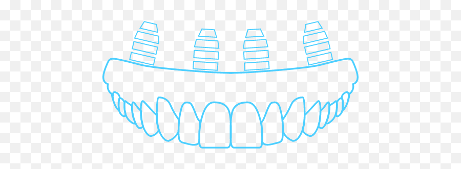 Hill U0026 Iopollo Oral Surgery Dental Implants Lubbock Tx - All On Four Dental Implants Vector Png,Implant Icon