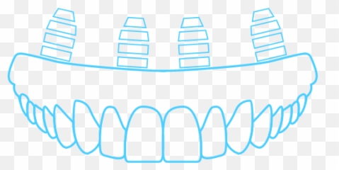 Hill U0026 Iopollo Oral Surgery Dental Implants Lubbock Tx - All On Four Vector png