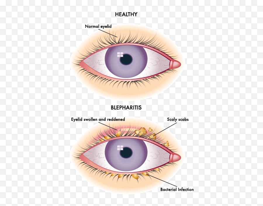 Blepharitis - Eye Specialists Of Delaware White Part Of The Eye Called Png,Eyelid Png