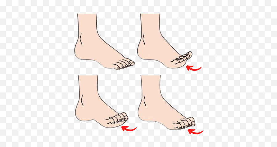 Claw Toe Curled Under Digits Next Step Foot U0026 Ankle Clinic - Do My Toes Curl Down Png,Toe 2 Icon