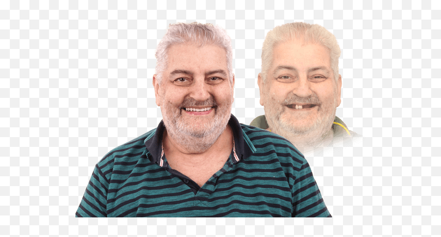 Dentures Aka False Teeth Implant - Supported Dentures Or All On 4 Senior Citizen Png,Dentures Png