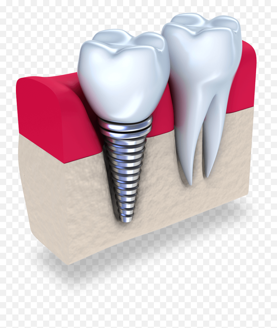 Dental Implants Davie Tooth Replacement Dr M Center - Single Teeth Png,Smile Teeth Png