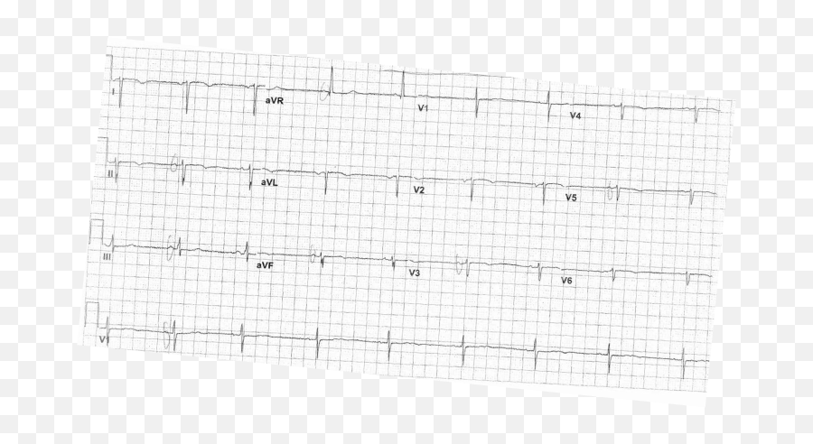 Carolinas Ekg Blog - Cmc Compendium Dot Png,Ekg Png