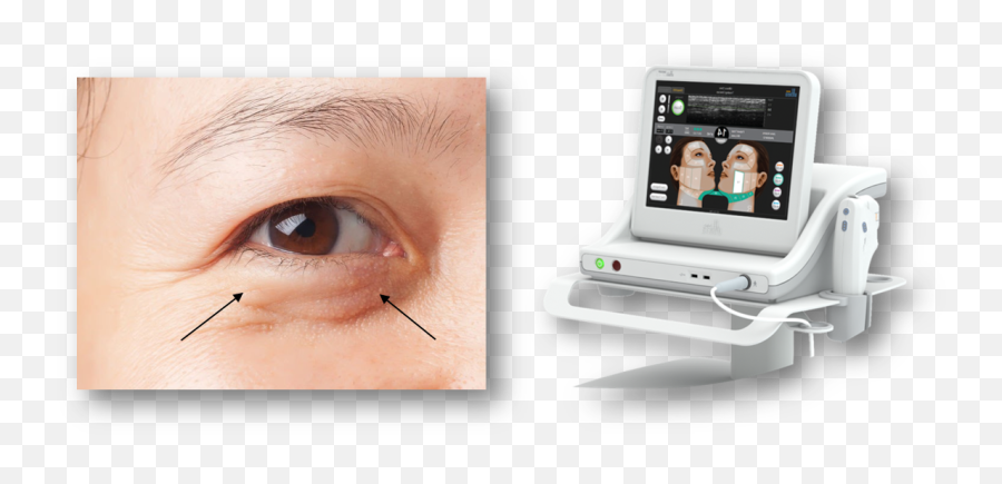 Eye Bags Removal Treatments In Malaysia Gem Clinic Png Triggered Eyes