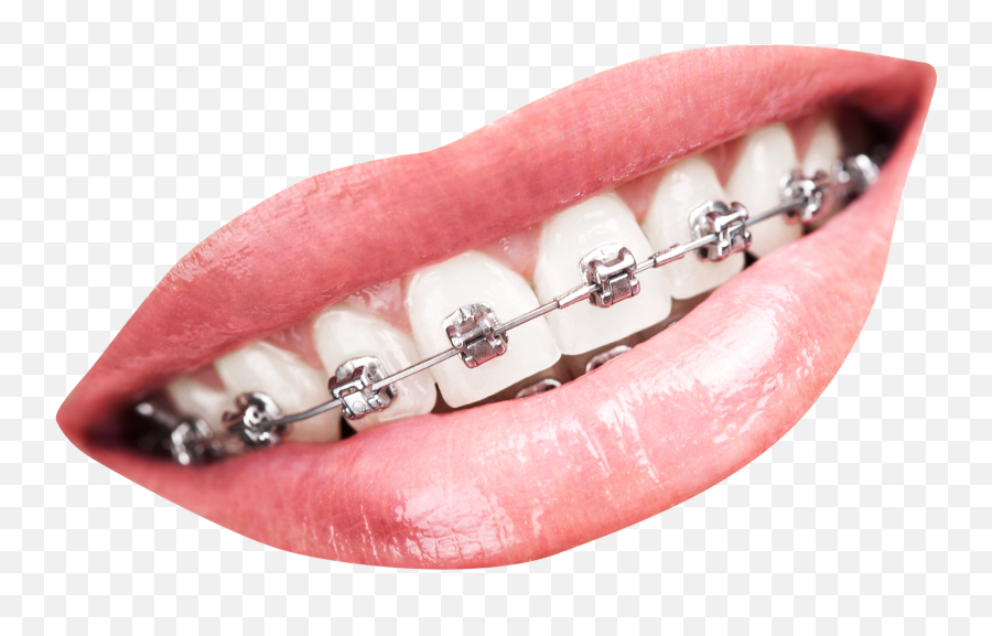Teeth With Braces Png Transparent Image - Pngpix Mouth With Braces Png,Mouth Png