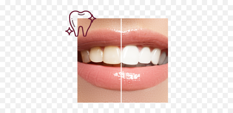 Teeth Whitening - Holland Cross Dental Teeth Whitening Png,Smile Teeth Png