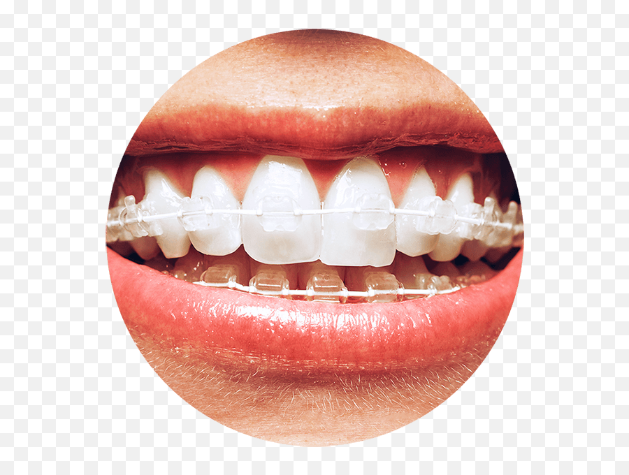 How Do Braces Work With Six Month Smiles - 6 Month Smile Braces Png,Smile Transparent