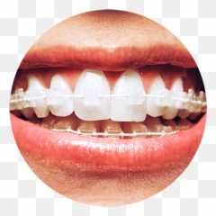 How Do Braces Work With Six Month Smiles - 6 png