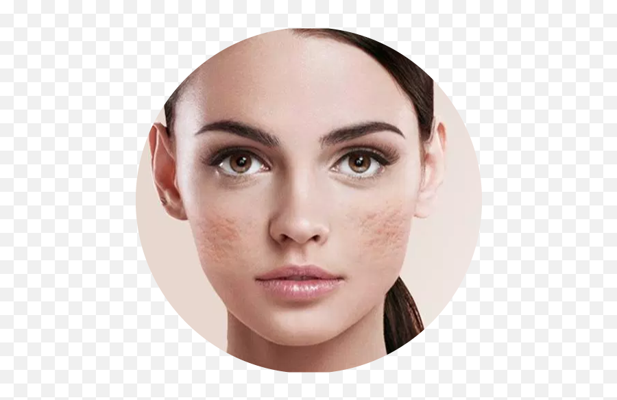 Pimple Acne Scar Removal Treatment In - Ratio Of Beautiful Face Png,Pimple Png