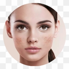 Pimple Acne Scar Removal Treatment In - Ratio Of Beautiful Face Png,Pimple Png