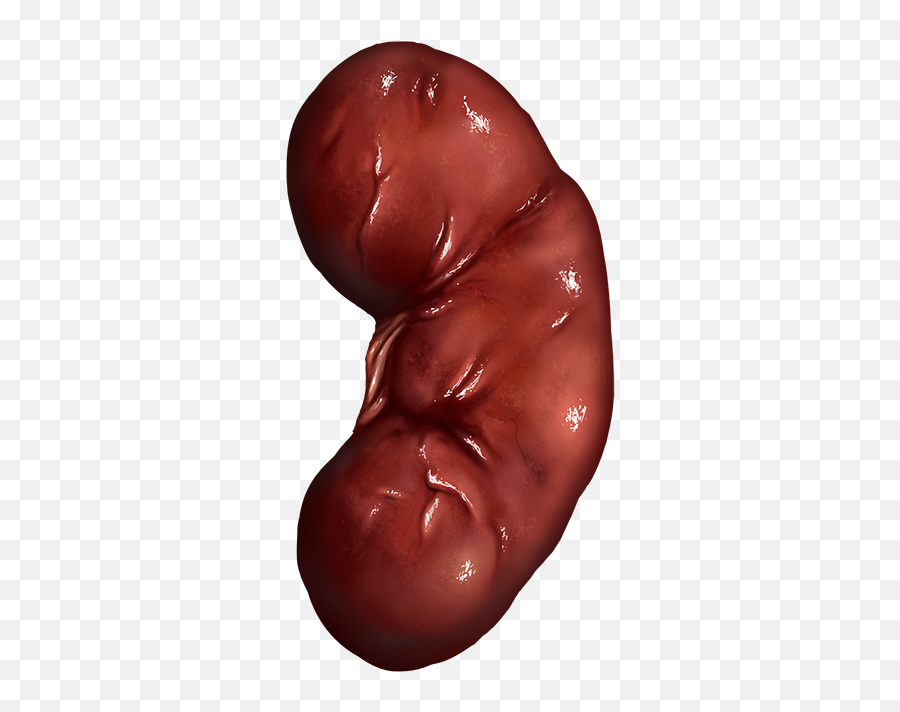 Kidney - Official Pathologic Wiki Solid Png,Kidney Png