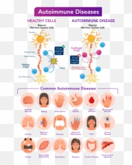 The Immune Response A Cellular War Letu0027s Talk Science - Autoimmune Disease Illustration png