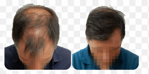 Fue Hair Transplant Procedure Advantages And Cost By - Fue Results png