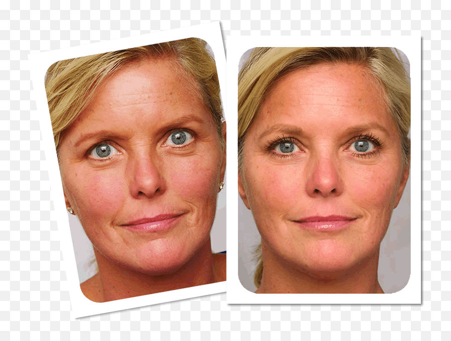 Lasers Phillips Aesthetic Dermatology - Wrinkle Removal Laser Before After Png,Palomar Icon Laser