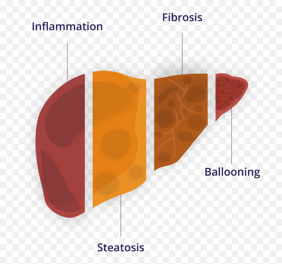 The Future Of Nash U0026 Nafld Research Is Non - Invasive Png,106.3 Nash Icon