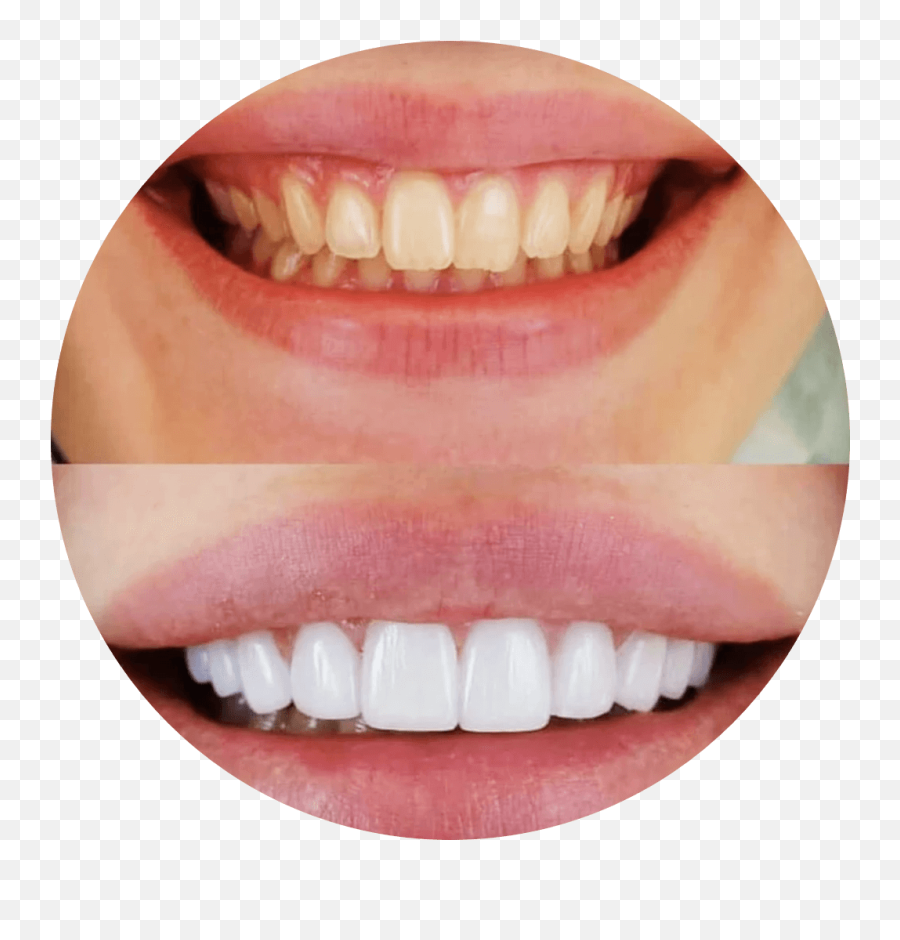 Snap - Nigel Newtons Dental Care Veneer Png,Smile Teeth Png