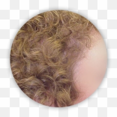 Hair Restoration San Diego Ca My Transplant Md - Design png