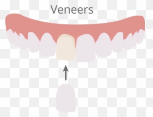 Cosmetic Dentistry In Bellevue Ne - Family Dentistry Of Bellevue Veneers Illustration Png,Smile Teeth Png