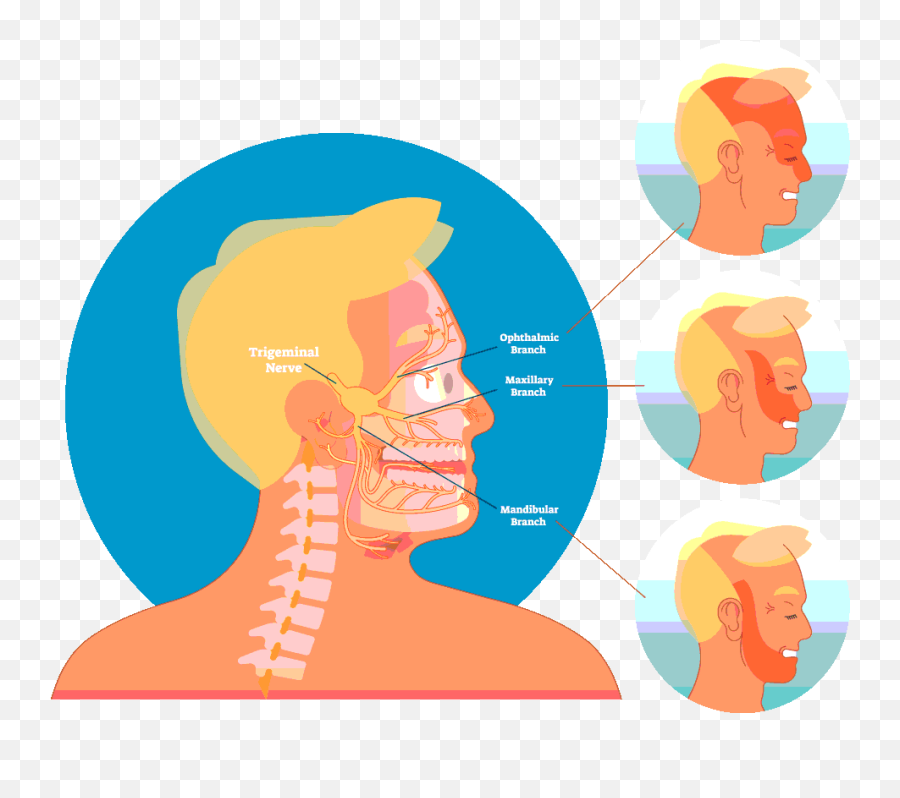 Trigeminal Neuralgia - Dr Prem Pillay Trigeminal Neuralgia Tumor Png,Gamma Knife Icon