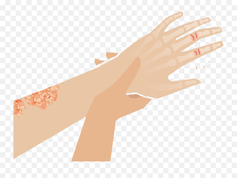 Psoriatic Arthritis - Clinlife Sign Language Png,Pointing At You Icon
