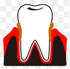 Dental Plaque Calculus Periodontal - Clip Art png