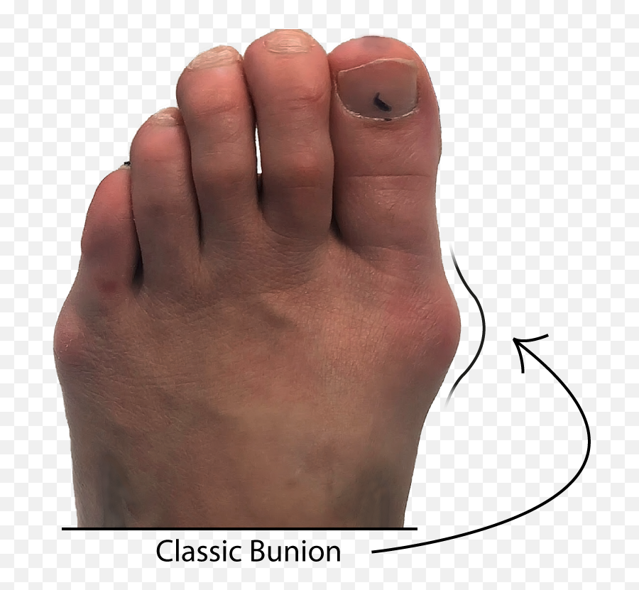 Bunion Symptom Checker - Toe Png,Toe Png