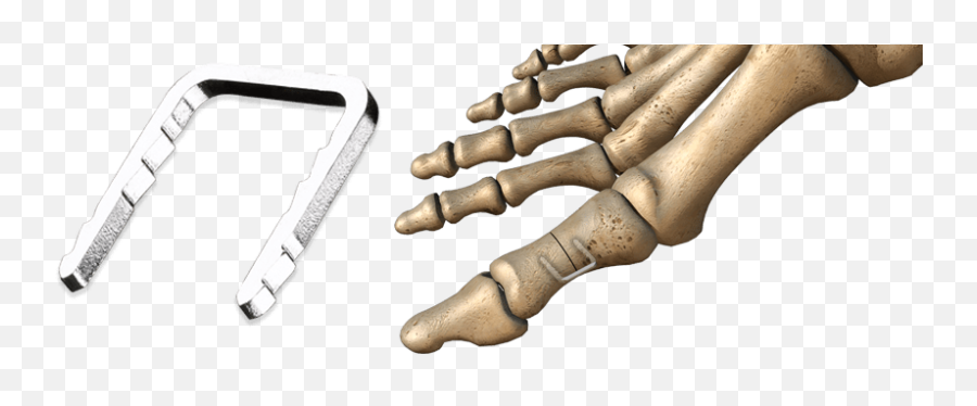 Charlotte Quick Staple Wright Medical Group - Hallux Valgus Agrafe Png,Staple Png