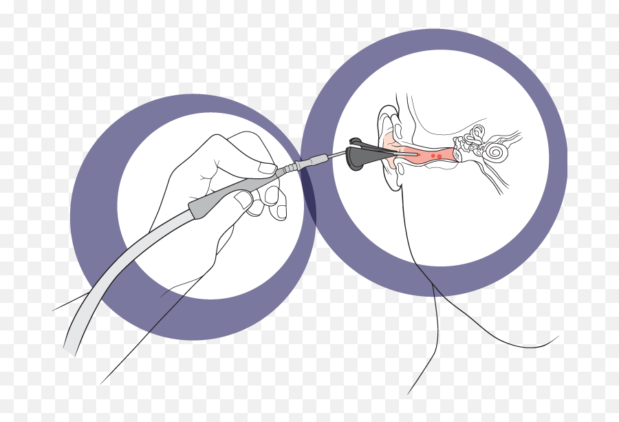 Geelong Ear Wax Clinic Removal Ear Micro Suction Diagram Png,Ear