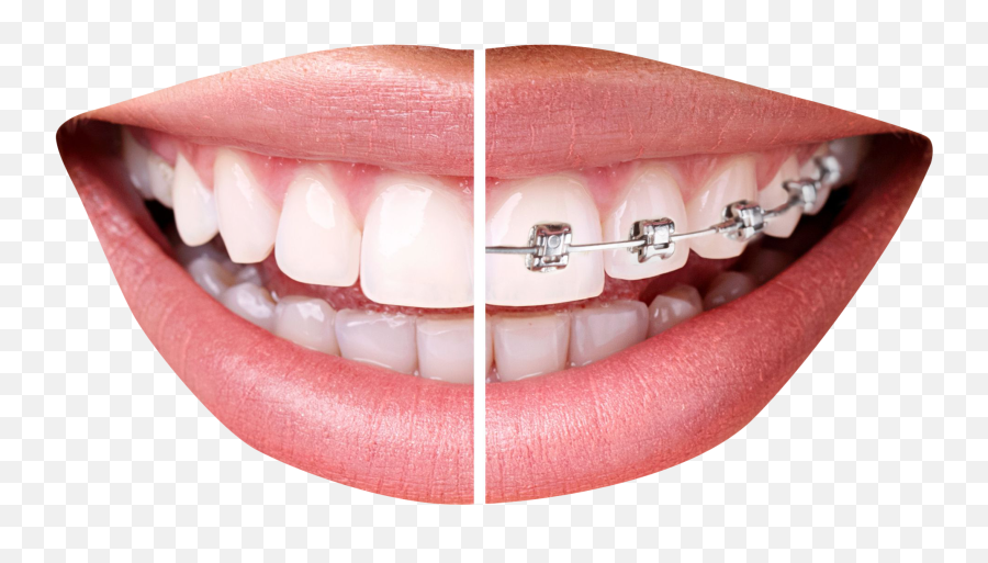 Download Free Png Teeth With Braces - Tooth Braces Png,Braces Png