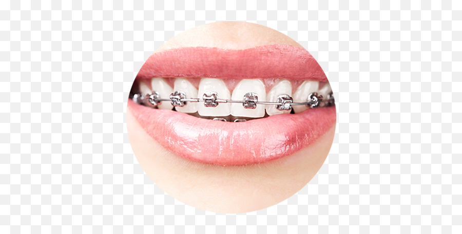 Traditional Braces - Braces Self Ligating With Rubber Png,Braces Png