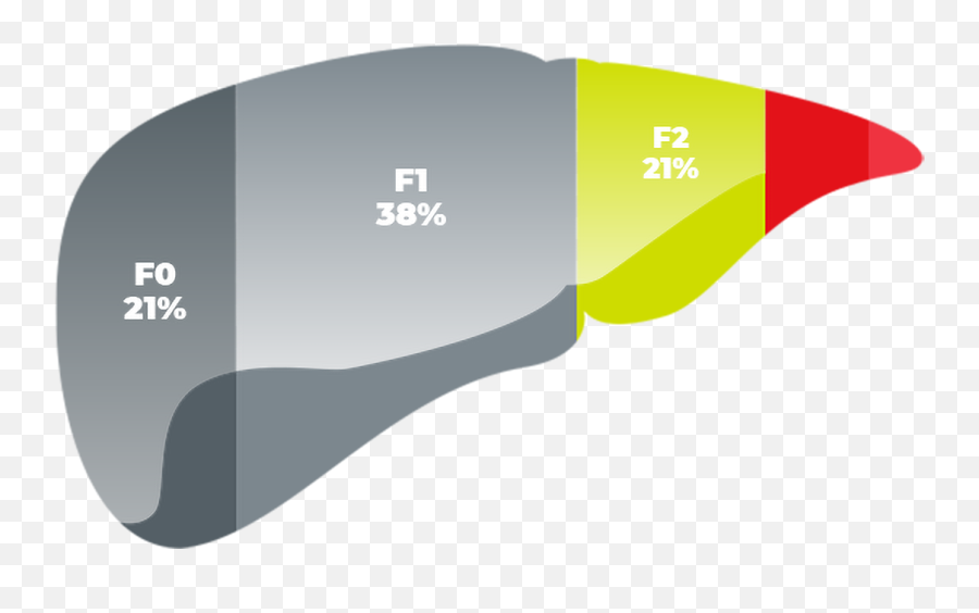 In Advanced Fibrosis Due To Nash Which Patients Are Transparent PNG