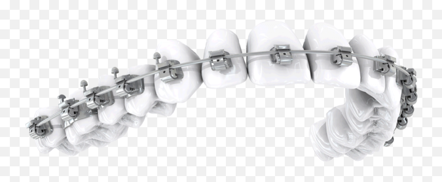Orthodontic Brackets Png Image With - Braces Png,Braces Png