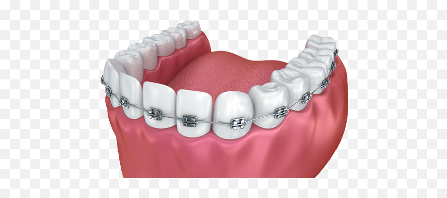 Download Braces - Dental Implant Png,Braces Png
