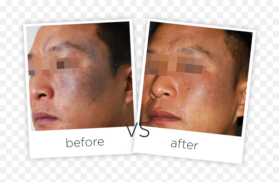Download Treatment Tattoo Removal And - Poster Png,Tear Drop Tattoo Png