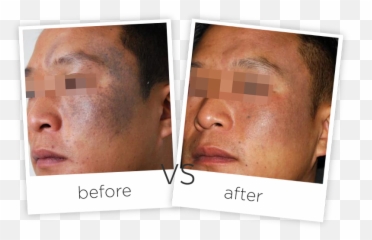 Download Treatment Tattoo Removal And - Poster png