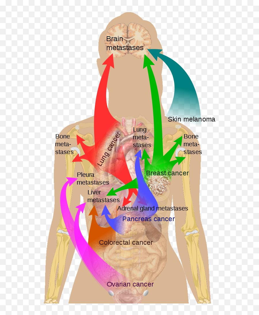 Filemetastasis Sites For Common Cancerssvg - Wikimedia Commons Sister Mary Joseph Node Png,Lung Png