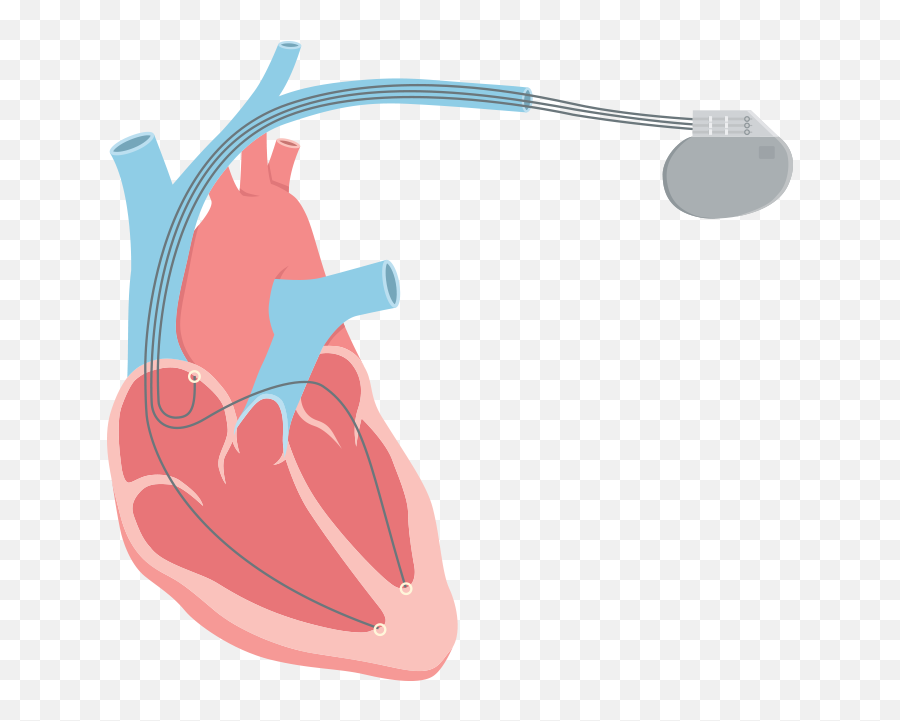 Systolic Heart Failure Also Called - Heart Failure Pngs,Failure Png