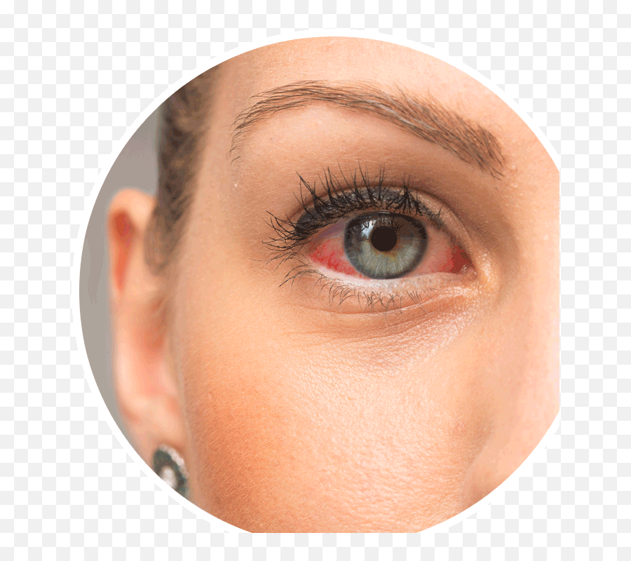 Red Eye Causes - La Jolla Ca Drs Gordon And Wildon Wong Lasik Red Eyes After Surgery Png,Red Eye Png
