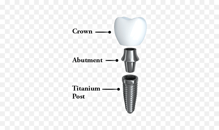 Dental Implants Serene Oaks The Solution For - Dental Implant Abutment And Crown Png,Jawbone Icon Earhook