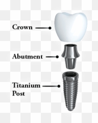 Dental Implants Serene Oaks The Solution For - Abutment And Crown png