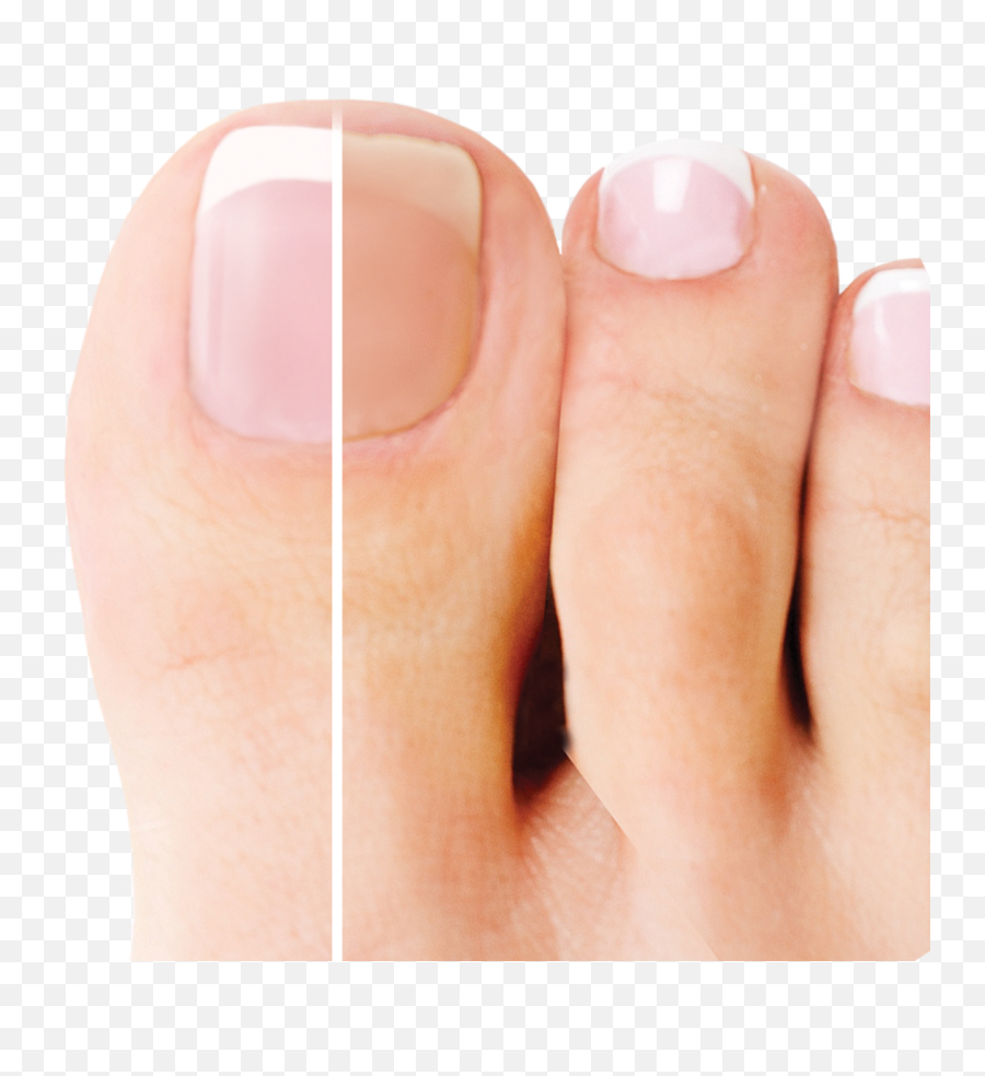 Fungex - A Single Application Fungex Toe Png,Nail Png