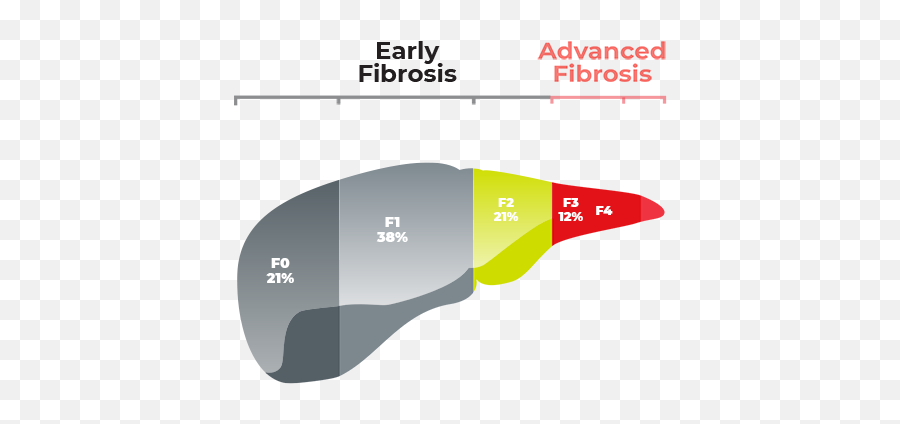 In Advanced Fibrosis Due To Nash Which Patients Are Transparent PNG