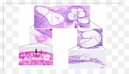 Photomicrograph Of The Left Temporal Bone Thin Arrow U003d Type - Sketch png