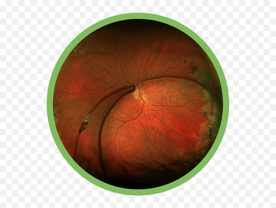 Colorado Retina Complex Anterior Segment Disease - Download Icon Adobe Premiere Png,Eye Glare Png