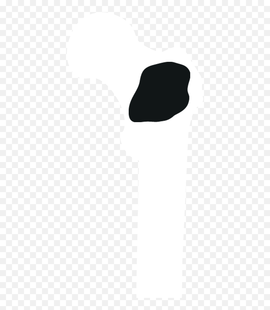 When Cancer Spreads To - Clip Art Png,Bone Transparent