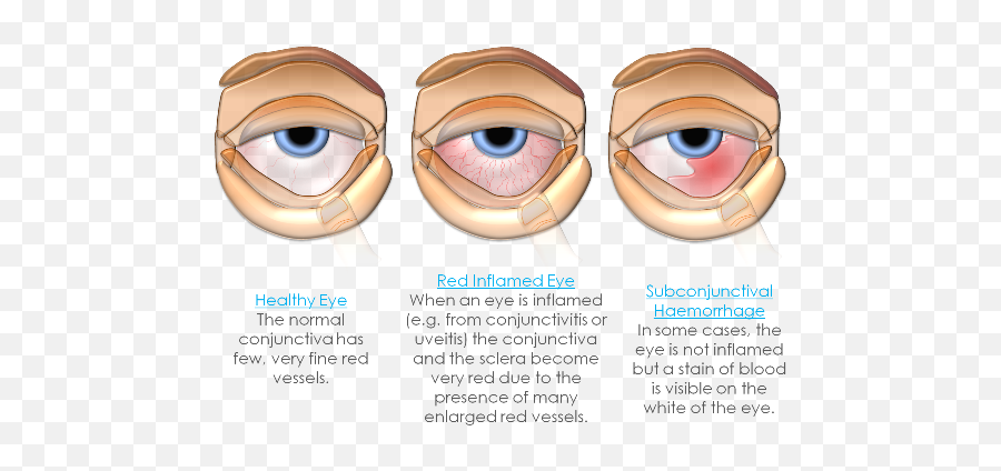 Pin - Anterior Uveitis Vs Scleritis Png,Red Eye Transparent