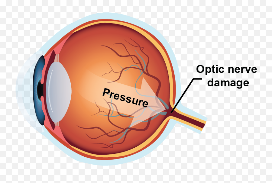 Glaucoma - A Complete Guide For 2020 Nrs Healthcare Diagram Png,Red Eye Png